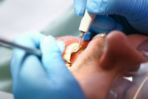 Best Emergency Root Canal Therapy in Great Falls, SC